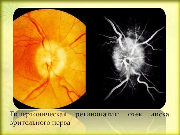 Гипертоническая ретинопатия: отек диска зрительного нерва