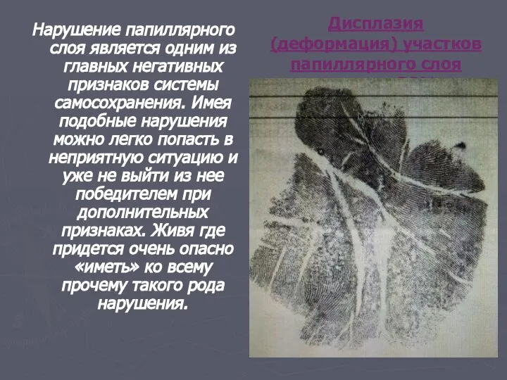 Дисплазия (деформация) участков папиллярного слоя ладони – 38% Нарушение папиллярного слоя является