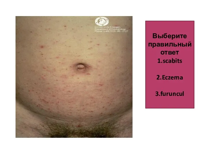 Выберите правильный ответ 1.scabits 2.Eczema 3.furuncul