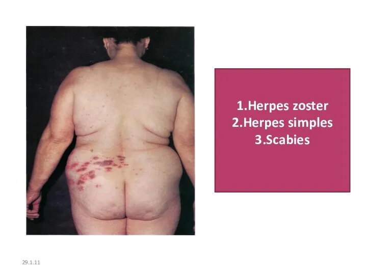 29.1.11 1.Herpes zoster 2.Herpes simples 3.Scabies