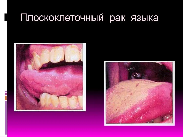 Плоскоклеточный рак языка