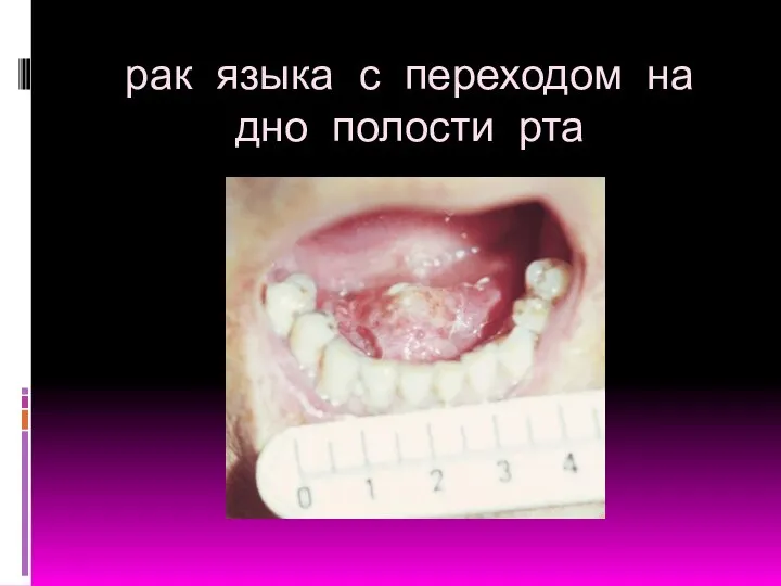 рак языка с переходом на дно полости рта