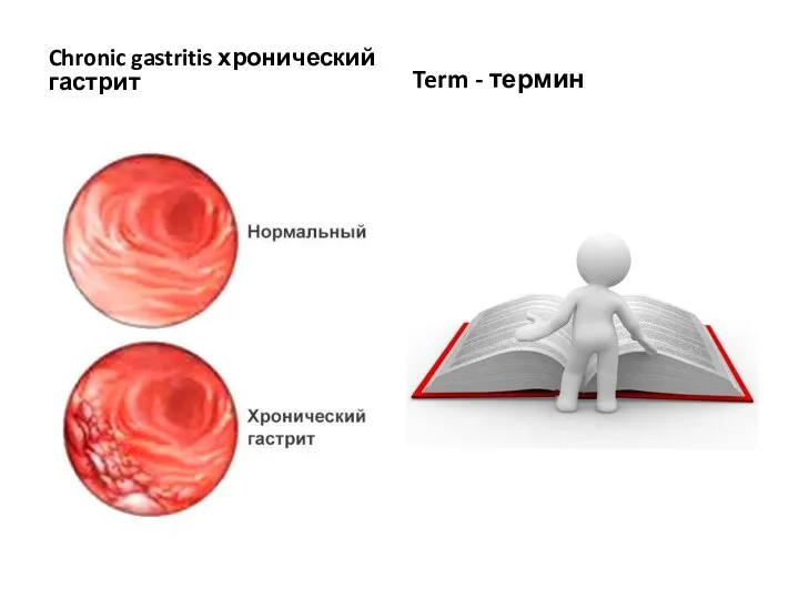 Chronic gastritis хронический гастрит Term - термин