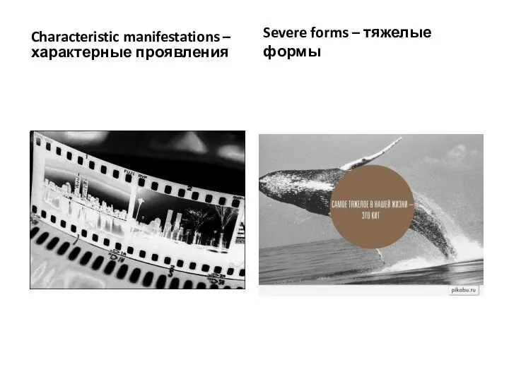 Characteristic manifestations – характерные проявления Severe forms – тяжелые формы