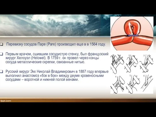 Перевязку сосудов Паре (Pare) производил еще в в 1564 году. Первым врачом,