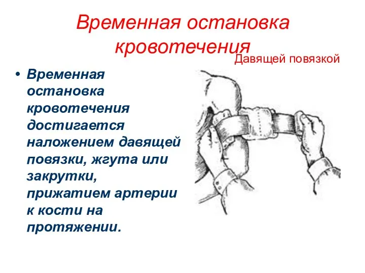 Временная остановка кровотечения Временная остановка кровотечения достигается наложением давящей повязки, жгута или