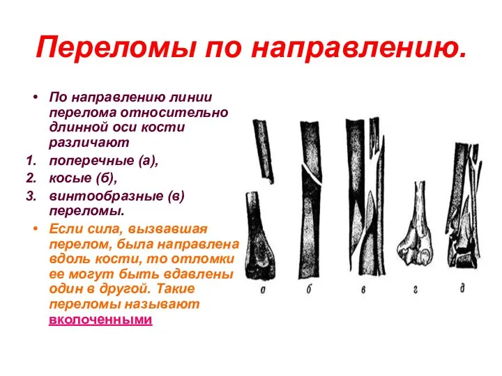 Переломы по направлению. По направлению линии перелома относительно длинной оси кости различают