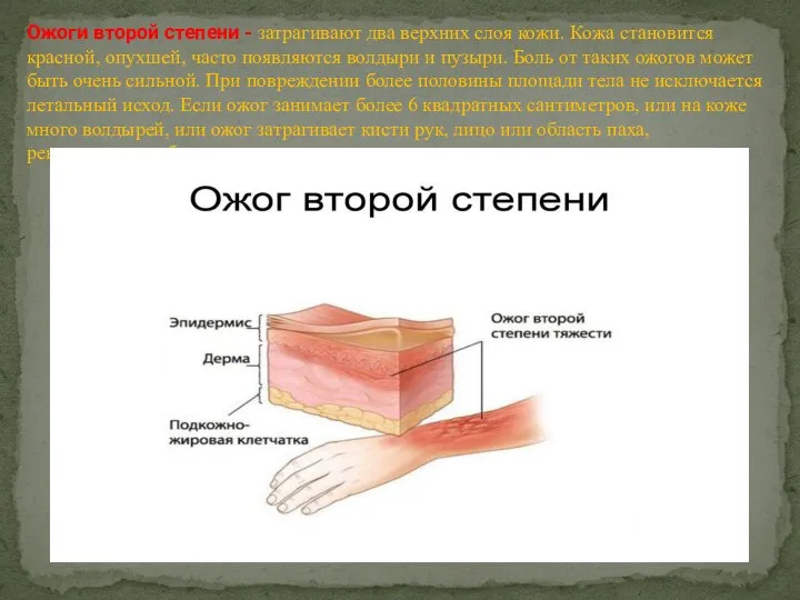 Ожоги второй степени - затрагивают два верхних слоя кожи. Кожа становится красной,