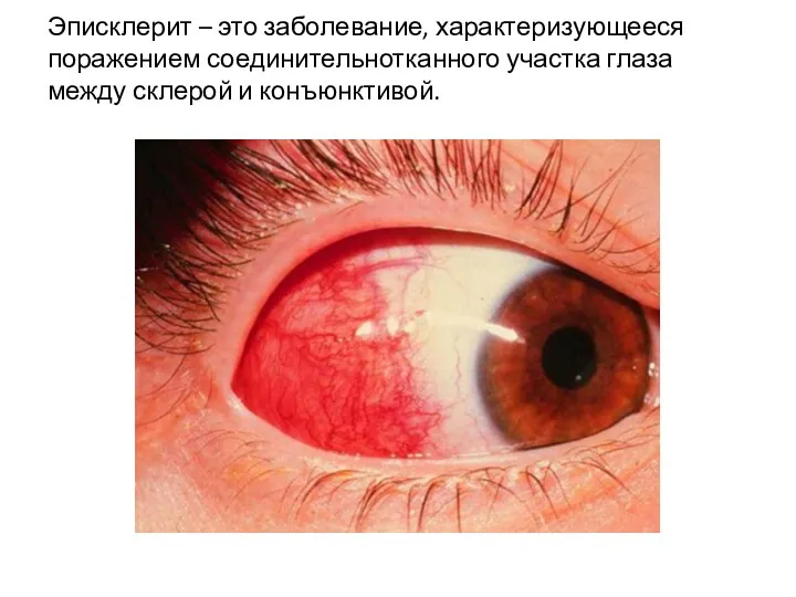 Эписклерит – это заболевание, характеризующееся поражением соединительнотканного участка глаза между склерой и конъюнктивой.