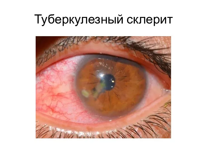 Туберкулезный склерит