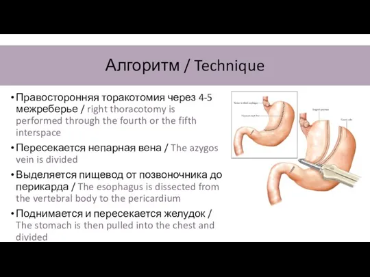 Правосторонняя торакотомия через 4-5 межреберье / right thoracotomy is performed through the