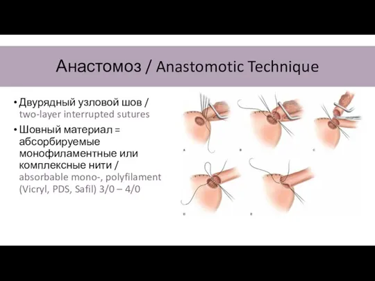 Анастомоз / Anastomotic Technique Двурядный узловой шов / two-layer interrupted sutures Шовный