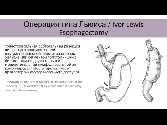 Операция типа Льюиса / Ivor Lewis Esophagectomy трансторакальная субтотальная резекция пищевода с