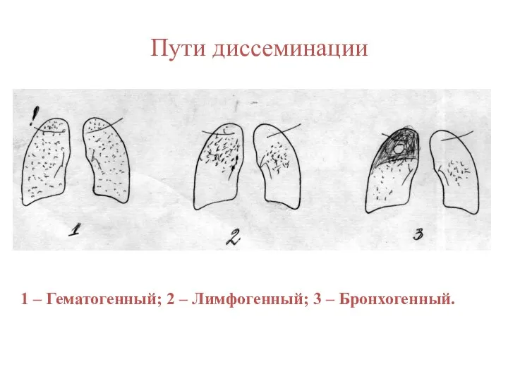 1 – Гематогенный; 2 – Лимфогенный; 3 – Бронхогенный. Пути диссеминации