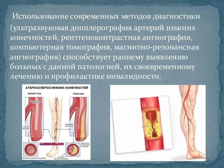 Использование современных методов диагностики (ультразвуковая допплерография артерий нижних конечностей, рентгеноконтрастная ангиография, компьютерная