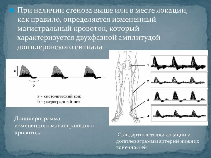 При наличии стеноза выше или в месте локации, как правило, определяется измененный