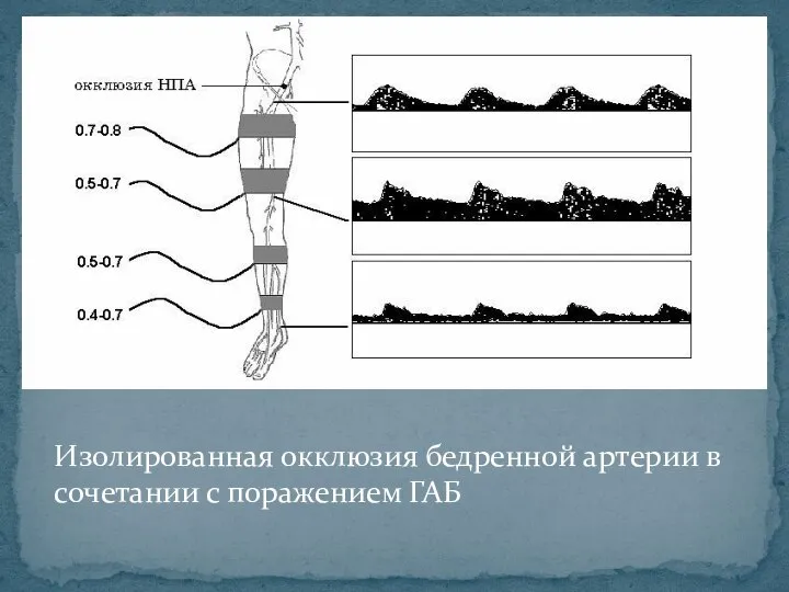 Изолированная окклюзия бедренной артерии в сочетании с поражением ГАБ