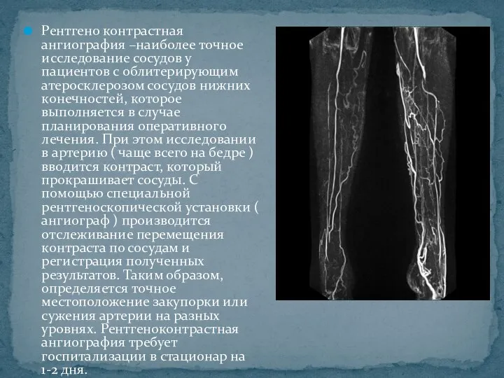 Рентгено контрастная ангиография –наиболее точное исследование сосудов у пациентов с облитерирующим атеросклерозом