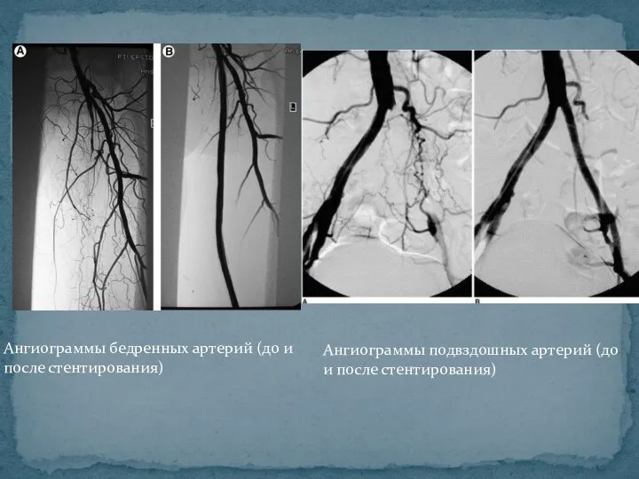 Ангиограммы бедренных артерий (до и после стентирования) Ангиограммы подвздошных артерий (до и после стентирования)