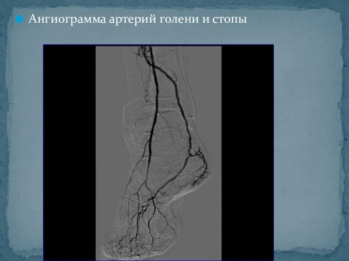 Ангиограмма артерий голени и стопы