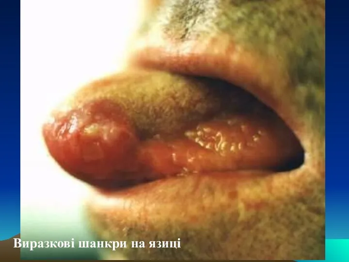 Виразкові шанкри на язиці