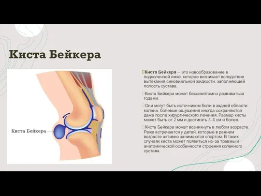 Киста Бейкера Киста Бейкера — это новообразование в подколенной ямке, которое возникает