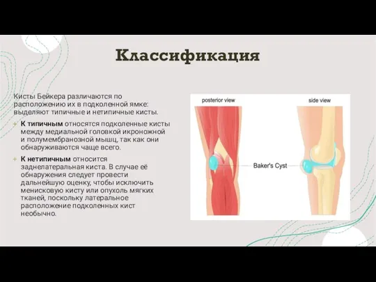 Классификация Кисты Бейкера различаются по расположению их в подколенной ямке: выделяют типичные