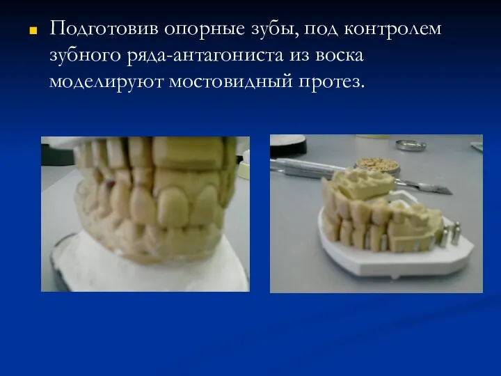 Подготовив опорные зубы, под контролем зубного ряда-антагониста из воска моделируют мостовидный протез.