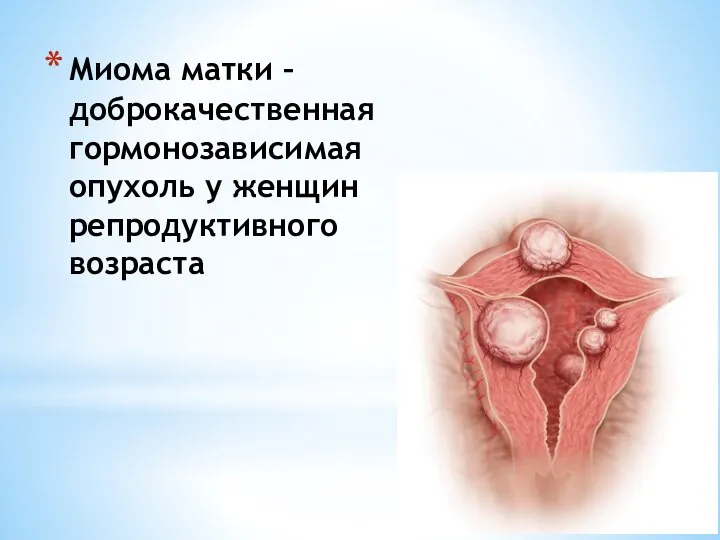 Миома матки – доброкачественная гормонозависимая опухоль у женщин репродуктивного возраста