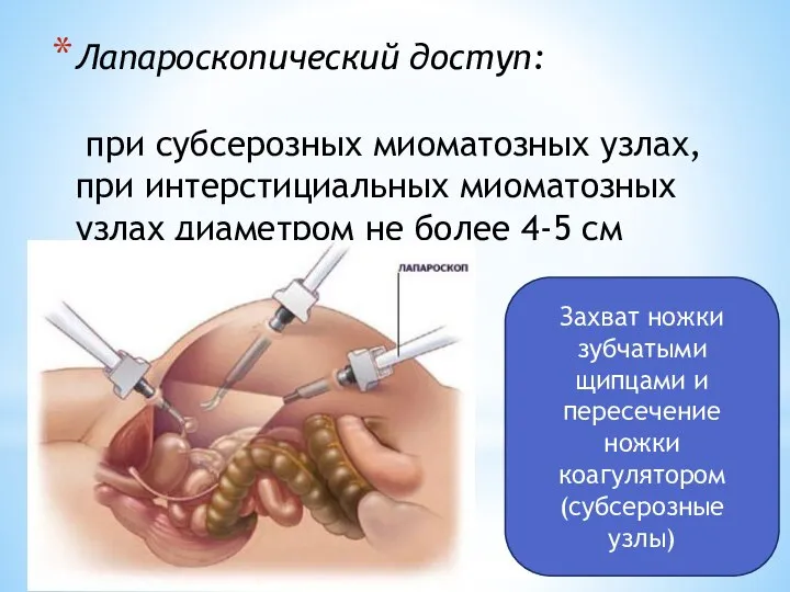 Лапароскопический доступ: при субсерозных миоматозных узлах, при интерстициальных миоматозных узлах диаметром не