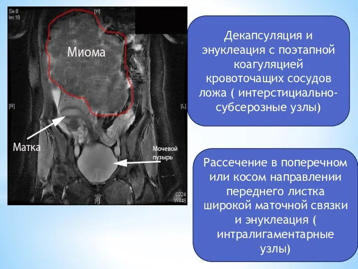 Декапсуляция и энуклеация с поэтапной коагуляцией кровоточащих сосудов ложа ( интерстициально-субсерозные узлы)