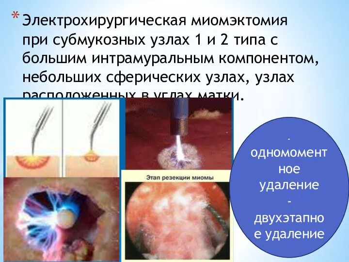 Электрохирургическая миомэктомия при субмукозных узлах 1 и 2 типа с большим интрамуральным
