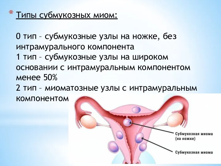 Типы субмукозных миом: 0 тип – субмукозные узлы на ножке, без интрамурального