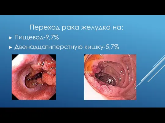 Переход рака желудка на: Пищевод-9,7% Двенадцатиперстную кишку-5,7%