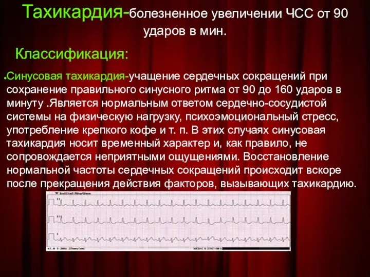 Тахикардия-болезненное увеличении ЧСС от 90 ударов в мин. Классификация: Синусовая тахикардия-учащение сердечных