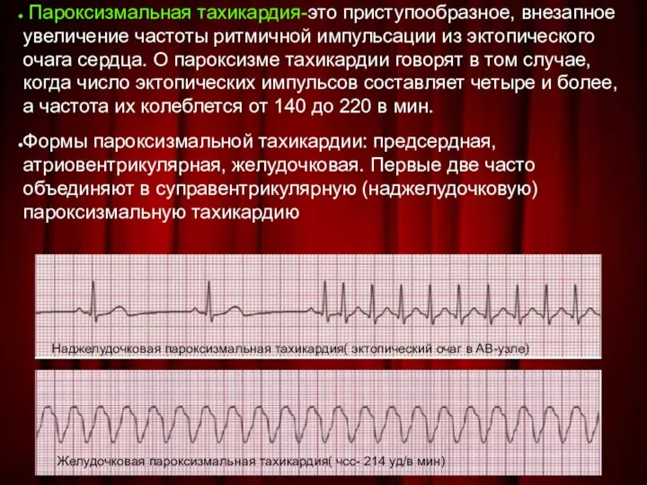 Пароксизмальная тахикардия-это приступообразное, внезапное увеличение частоты ритмичной импульсации из эктопического очага сердца.