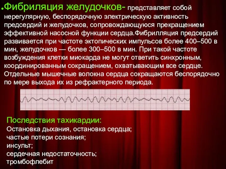 Фибриляция желудочков- представляет собой нерегулярную, беспорядочную электрическую активность предсердий и желудочков, сопровождающуюся