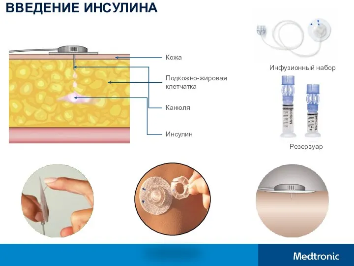 ВВЕДЕНИЕ ИНСУЛИНА Кожа Подкожно-жировая клетчатка Канюля Инсулин Резервуар Инфузионный набор