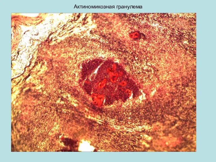 Актиномикозная гранулема