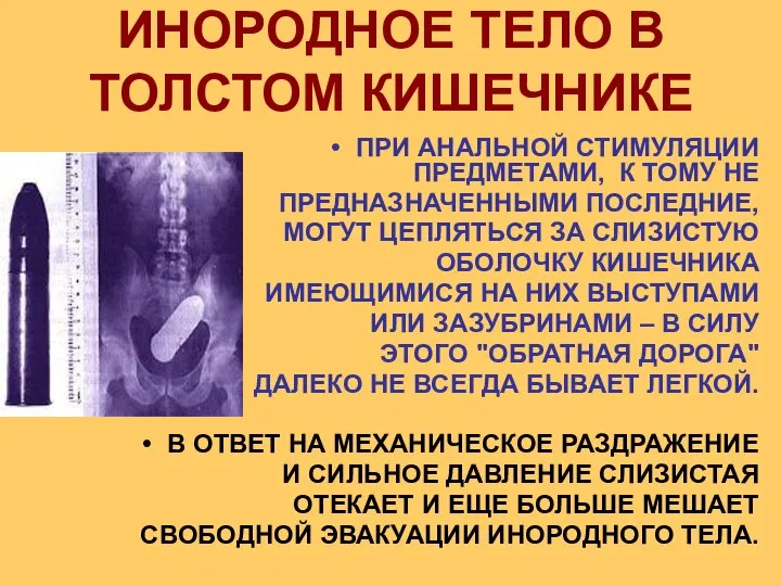 ИНОРОДНОЕ ТЕЛО В ТОЛСТОМ КИШЕЧНИКЕ ПРИ АНАЛЬНОЙ СТИМУЛЯЦИИ ПРЕДМЕТАМИ, К ТОМУ НЕ