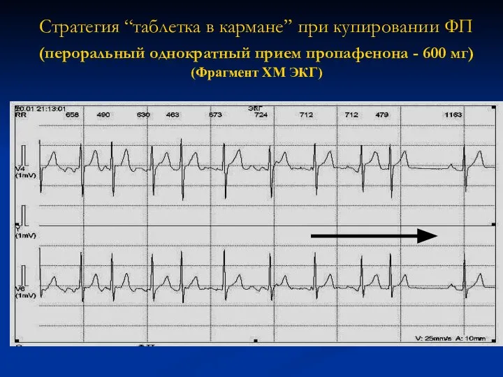 Стратегия “таблетка в кармане” при купировании ФП (пероральный однократный прием пропафенона -