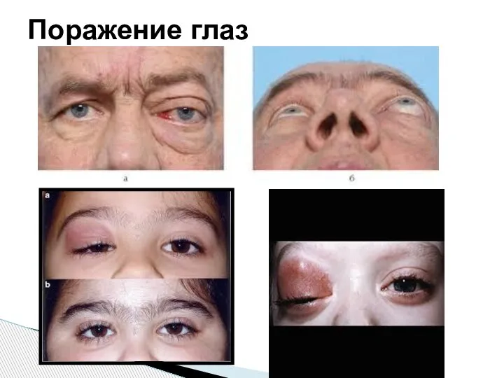 Поражение глаз