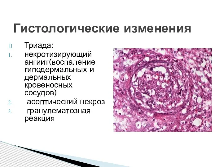 Гистологические изменения Триада: некротизирующий ангиит(воспаление гиподермальных и дермальных кровеносных сосудов) асептический некроз гранулематозная реакция