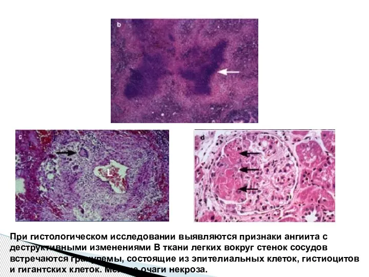 При гистологическом исследовании выявляются признаки ангиита с деструктивными изменениями В ткани легких