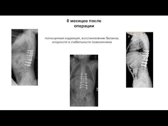 8 месяцев после операции полноценная коррекция, восстановление баланса, опорности и стабильности позвоночника