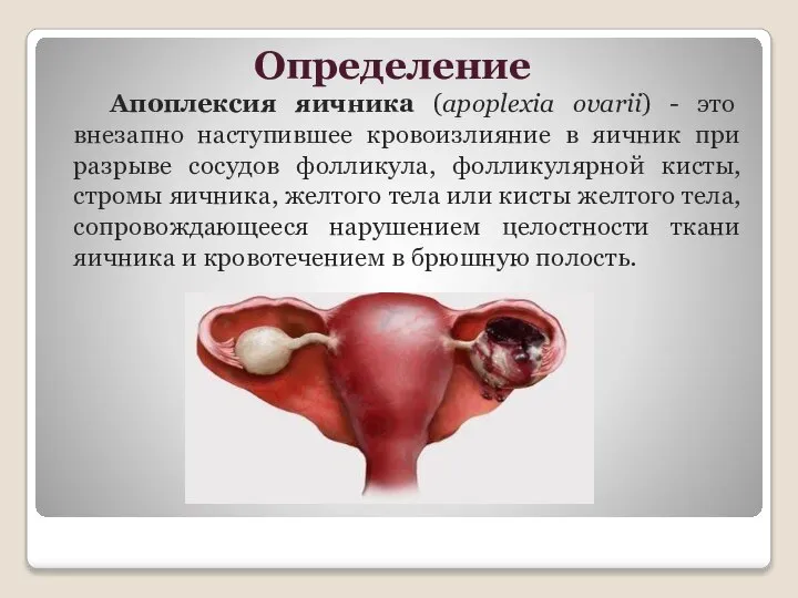 Определение Апоплексия яичника (apoplexia ovarii) - это внезапно наступившее кровоизлияние в яичник