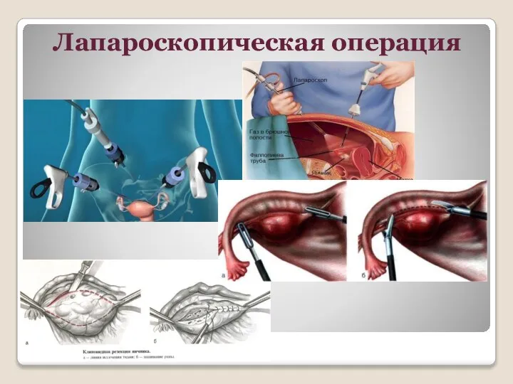 Лапароскопическая операция