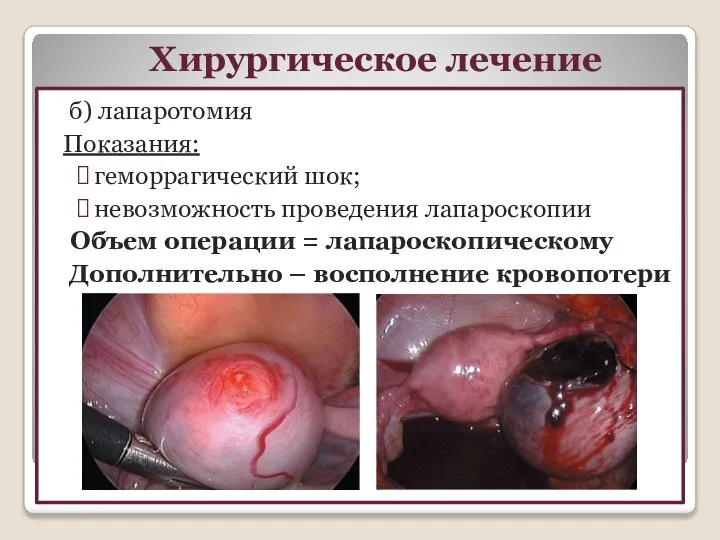 Хирургическое лечение б) лапаротомия Показания: геморрагический шок; невозможность проведения лапароскопии Объем операции