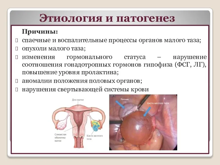 Этиология и патогенез Причины: спаечные и воспалительные процессы органов малого таза; опухоли