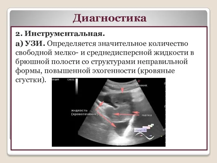 2. Инструментальная. а) УЗИ. Определяется значительное количество свободной мелко- и среднедисперсной жидкости